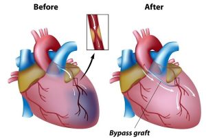 evend-sepeda-triple-bypass-solusi-alternatif-untuk-penyakit-jantung